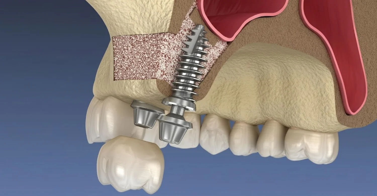 Dental Implant Sinus Perforation 2